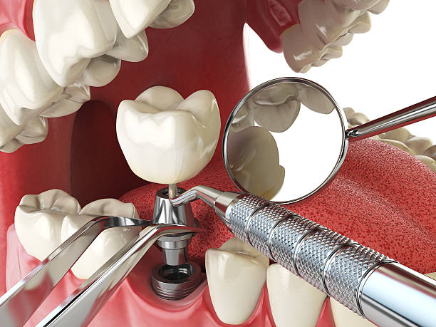 Best Emergency Root Canal Treatment in Lockland, OH